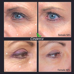 Cinderra Eye Gel instantly reduces wrinkles crow’s feet puffiness & facial lines