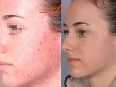 Ane Lumiere 30 Salicylic Acid Peel Chemical Peel Kit Acid Peeling For Face