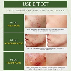 Natural Acne Removal Cream for Oily & Combination Skin | Clears Pimples & Pores