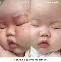 Evereden Healing Eczema Treatment Cream 1.7oz Fragrance Free Baby Kids Adult