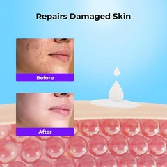 Folliculitis Treatment Cream 4.23oz Acne Ingrown Hair Relief Remover