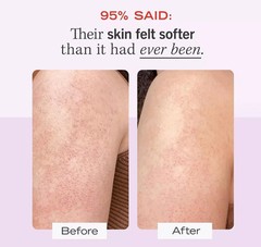 KP Bump Eraser Body Scrub – 10% AHA Exfoliator for Smooth, Soft Skin 10 Oz