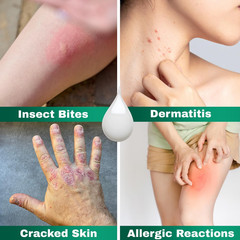 Plus Cream Skin Allergies Aloe Vera with 1% Hydrocortisone Maximum Strength Anti