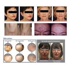 Pro 7 Colors BIO PDT LED Light Facial Skin Rejuvenation Photon Therapy Machine