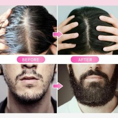 2.0mm Derma Roller Hair Regrowth Micro Needle Roller Beard Growth Anti Hair Loss