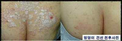 3 Lot of ISAL Atopy Eczema Cream Lotion./Made in USA
