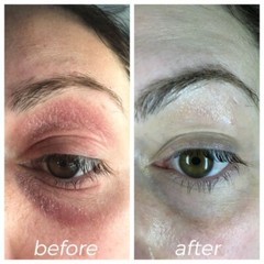 Eyelid Eczema Eye eczema non steroid with pure organic supplements