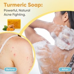 Treeroot 5 Pack Turmeric Soap, 80g Kojic Acid and 1 Count (Pack of 5)