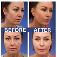 2 Pk – Matrixyl 3000, Argireline Hyaluronic Acid AntiAging Wrinkle SERUM + CREAM