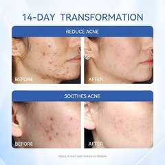 Dr.Leo Acne Essence Salicylic Acid Anti-acne Serum Lighten Acne Scars acne NEW