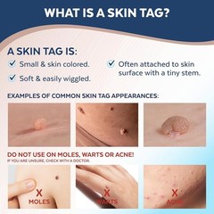 Advanced Cryogenic Skin Tag Removal Kit – 10 Treatments, Results in 7-14 Days