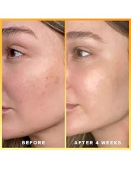 KOJIC ACID Skin Whitening Lightening Brightening Serum Bleaching/Spot Fade Cream
