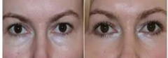 Eye Serum