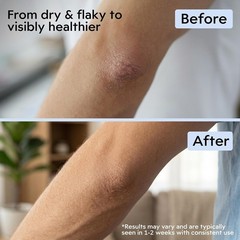 Manuka Honey Gel Cream for Eczema 1 Ounce Fragrance Free Lightweight Moisturizer